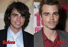 Excuses for missing work for plastic surgery. Reid Ewing Plastic Surgery Before And After3 Celebrity Plastic Surgery Plastic Surgery Reid Ewing