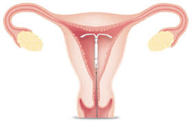 An iud has strings that hang down into the vagina. What Is Skyla Skyla Us Patient