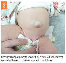 Image result for Umbilicus botryoides