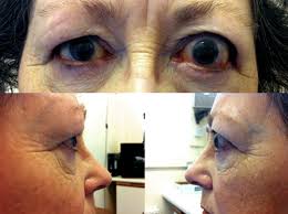 Image result for Proptosis