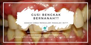 Sekarang ini banyak sekali produk yang dijual di pasaran untuk mengatasi gigi bengkak. Klinik Pergigian Dr Norsyafiqah Haiii Assalamualaikum Harini Nak Share Ngan Ampaa Pasai Gusi Bengkak Dan Bernanah Pernah Rasa Dak Lepaih Tampal Gigi Pastu Jadi Bengkak Atau Gigi Macam Dok Elok Lagi