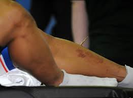 A scan late on saturday night assessed the injury, but medics opted to wait until tackling the splinter, which was around 20cm long. Awang Needs Surgery To Remove Huge Splinter Cycling Weekly