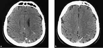 Cerebral venous thrombosis (cvt) is an uncommon disorder in the general population. Figure 3 From Overlooked Early Ct Signs Of Cerebral Venous Thrombosis With Lethal Outcome Semantic Scholar
