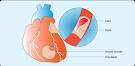 INFARCTUS - Dfinition, symptmes, causes, complications. Tests