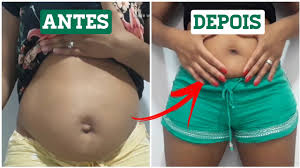 Um Mes Pos Operatorio De Hernia Umbilical Novo Umbiguinho Youtube