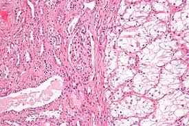 Kidney cancer recurrence & survival rates. Renal Cell Carcinoma Wikipedia