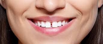 Diastemas appear most commonly between the two upper front teeth although it is possible to have gaps between any two teeth or multiple teeth. Front Teeth Space Correction In Ballarat Teeth Space Correction In Delacombe