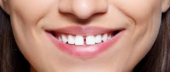 Researchers have said that about 20% of the world's population has a diastema or gapped teeth. Front Teeth Space Correction In Ballarat Teeth Space Correction In Delacombe
