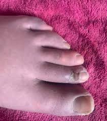 See it bigger in her… [ this dead city was once our home. Mum S Warning To Parents Over Covid Toes After Son S Feet Swelled And Scabbed In Painful Frostbite Blisters Daily Record