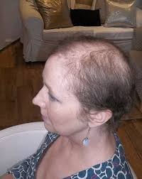 Unfortunately, appropriate head coverings are often difficult to find and expensive when available, while simple sewing patterns are scarce as well. Health Coping With Hair Loss After Cancer Daily Mail Online