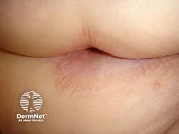 Image result for itchy skin rectum