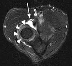 Radial Tunnel Syndrome Hand Orthobullets