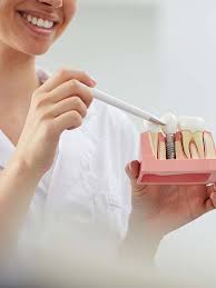 There are some exceptional cases where patients can get free dental implants on the nhs (or at least pay a heavily reduced fee). Metal Free Dental Implants Replace Your Missing Teeth