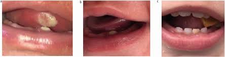 Image result for Neonatal Teeth