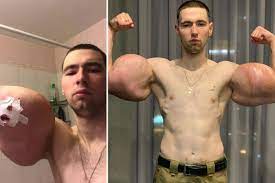 Dos santos soon found more dangerous ways of injecting himself with the oil, to the point where his muscles started to solidify and i couldn't even inject my arms — they were full of rocks. Russian Bodybuilder With 24 Inch Oil Injected Popeye Biceps Has Surgery To Save Arms After Warnings He D Die