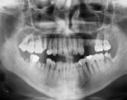 Wisdom teeth removal cost (in the uk). Springfield Wisdom Tooth Removal Brookwater Dental