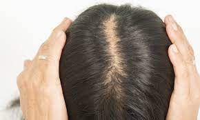 Female Hair Loss: Causes, Treatments & Hair Thinning Prevention in Women