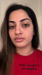 Still veryyy early in the healing process but NO REGRETS 👃🏽 @P.A.S. . . .  . @Lisa @Brian Bassiri-Tehrani, MD #fyp #foryou #rhinoplasty #nosejob  #septoplasty #alarplasty #rhinoplastycastremoval ...