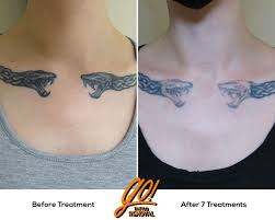 What is the tattoo removal? Only Want A Portion Of Your Tattoo Removed We Can Help With That Every Tattoo Will Have Different Results We Post A Wide Variety Of Images To Help Set Realist