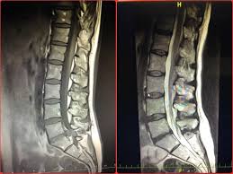 Image result for vyhřezlá ploténka