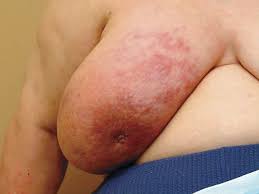 How quickly does it spread externally from there? answered by dr. Approach To Inflammatory Breast Cancer Abstract Europe Pmc