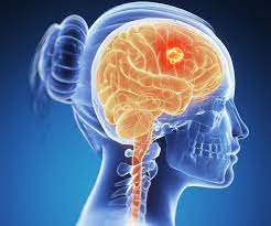 Maybe you would like to learn more about one of these? Cancer 9 Simptome Provocate De Tumorile Cerebrale Nu Le Ignora SÄƒnÄƒtate Oncologie Eva Ro