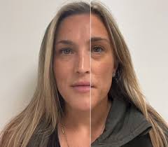 You don't have to be frozen 🥶 Many clients also prefer a more natural  approach to help achieve a more youthful look and allowing facial  expressions and movement still. This is where