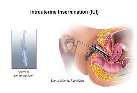 Iui Treatment Cost In India How Much Does Iui Cost In India 2021