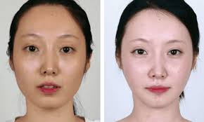 V-Line Jaw Surgery Cost in Durban