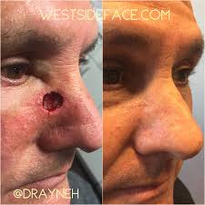 Skin cancer is the most common type of cancer in the united states by a pretty large margin, and it does not discriminate. Complex Nasal Skin Cancer Reconstruction Westside Face