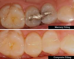 Do you know how much a filling could set you back? What Are Composite Fillings Aka White Fillings United Dentist