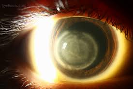 Keratitis is a painful eye inflammation that can be very serious. Herpes Simplex Virus Hsv Disciform Keratitis