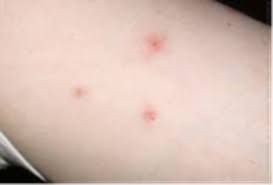 Maybe you would like to learn more about one of these? Invisible Bugs Cause Major Discomfort Garden Talk Al Com