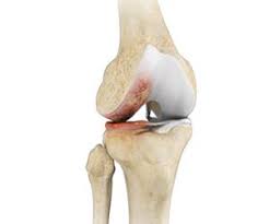 Image result for Polymyalgia Rheumatica