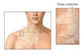 It's also called pityriasis versicolor. How Did I Get Tinea Versicolor Is It Curable Quora