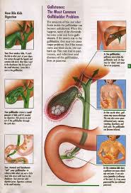 Master Liver Gallbladder Flush The Holy Kale Gallbladder Flush Gallbladder Cleanse Kidney Detox Cleanse