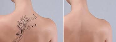 Tattoo removal creams work by bleaching or peeling away the top layer of the skin. Tattoo Removal Skin Procedures