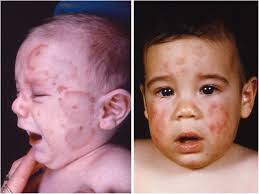 Neonatal Systemic Lupus Erythematosus Syndrome: a Comprehensive Review