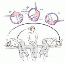 Canalith Repositioning Procedure For Vertigo Active Treatment Of Bppv Vertigo Treatment Tinnitus Remedies Vertigo Exercises