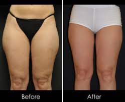 What To Do About Inner Thigh Sagging