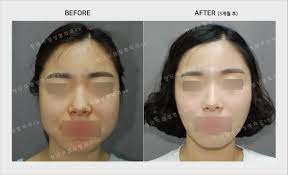 To relieve symptoms of a medical condition or improve your face shape. A Complete Guide To Getting Jaw Botox In Korea