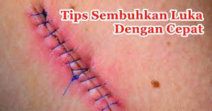 Hiu paus dapat sembuhkan luka yang sangat serius dalam waktu yang cepat. Cara Menyembuhkan Luka Pembedahan Dengan Cepat Ini Yang Boleh Anda Buat
