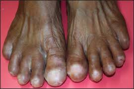 Image result for Onychotillomania feet