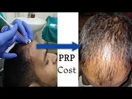 Does prp or platelet rich therapy for hair lead. Hair Loss Treatment Prp Therapy Cost Platelet Rich Plasma Youtube