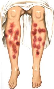 Image result for erythema nodosum