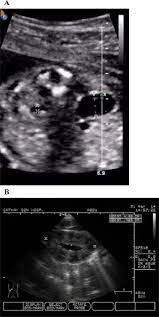 Frequency Of Postnatal Hydronephrosis In Infants With A Renal Anterior Posterior Pelvic Diameter 4 Mm On Midtrimester Ultrasound Sciencedirect