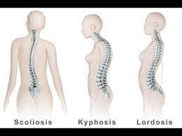 Spinal Curvature Dr Joel Wallach Skoliosis Desain Logo Bisnis Tulang