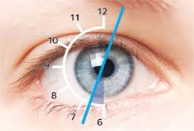During the fitting, the provider will ask the patient about what kind of lenses. Toric Fitting Guidelines Coopervision Singapore