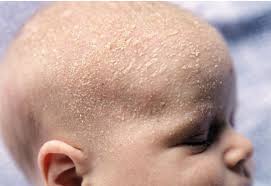 Babies often lose their hair during the first six months. Cradle Cap My Hair Doctor Prescription Haircare