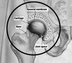 Certain medical conditions and medications that suppress people's immune systems can make them more. Osteoarthritis Of The Hip Hip Arthritis Uw Orthopaedics And Sports Medicine Seattle